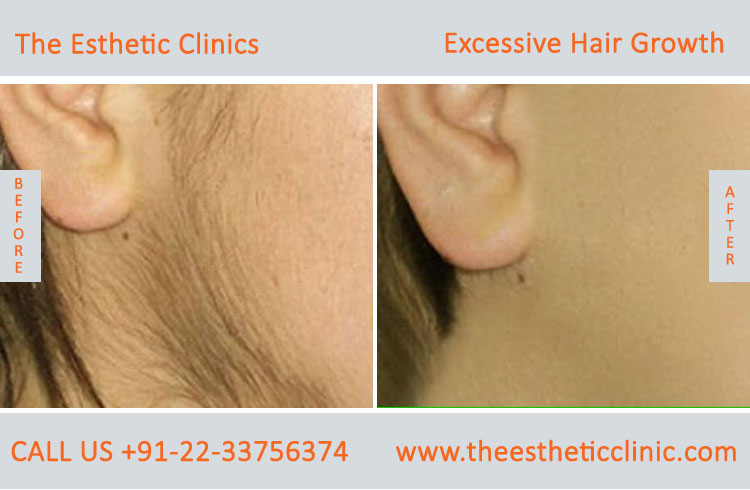 Excessive Hair Growth Removal Treatment before after photos in mumbai india (6)